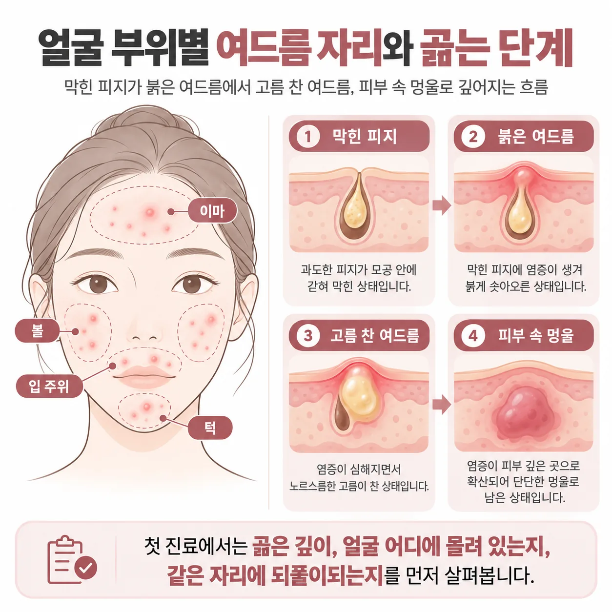 얼굴 부위별 여드름 자리와 막힌 피지가 곪는 여드름으로 깊어지는 단계 개념도