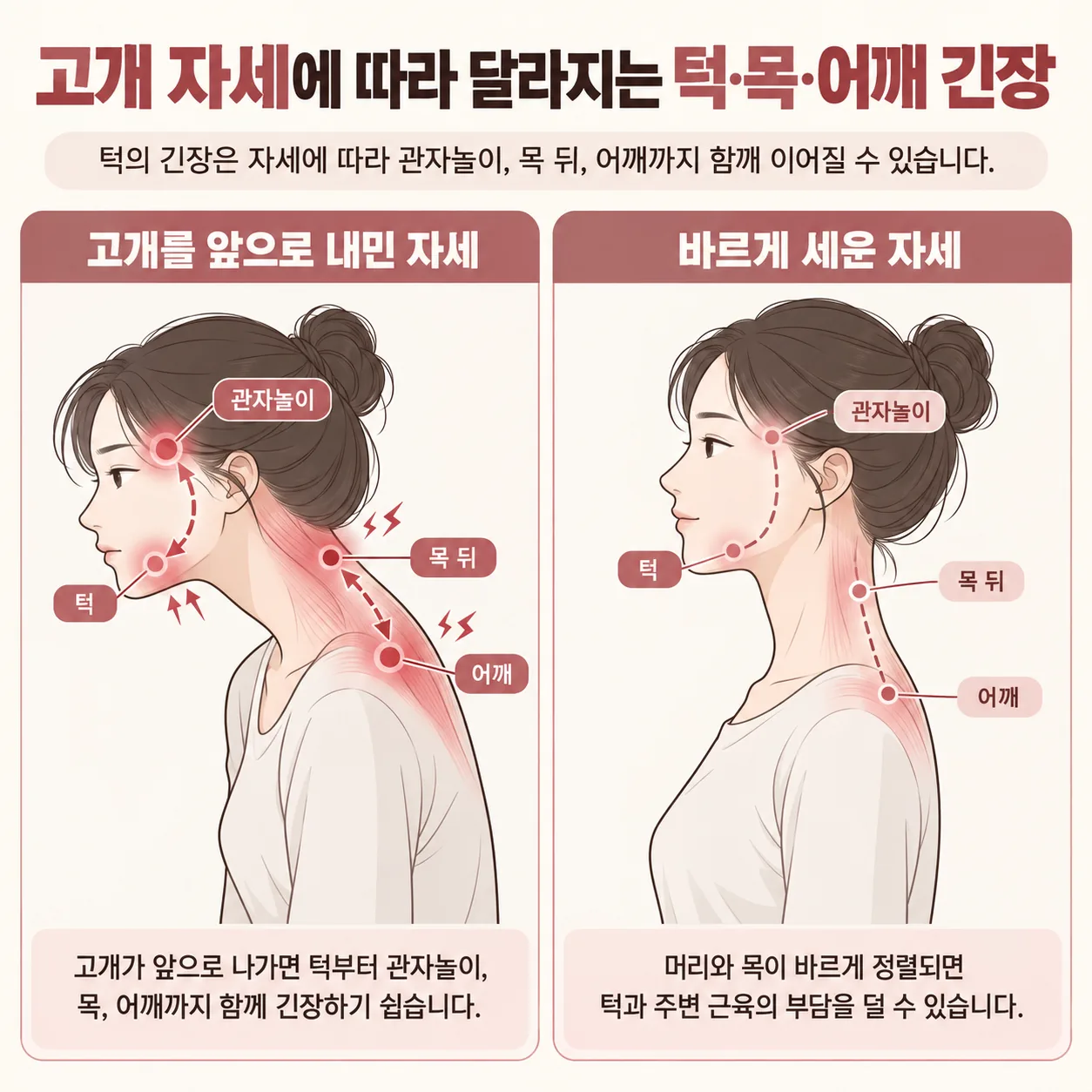 고개를 앞으로 내민 자세에서 턱과 관자놀이, 목과 어깨 근육이 함께 긴장하는 연결 도식