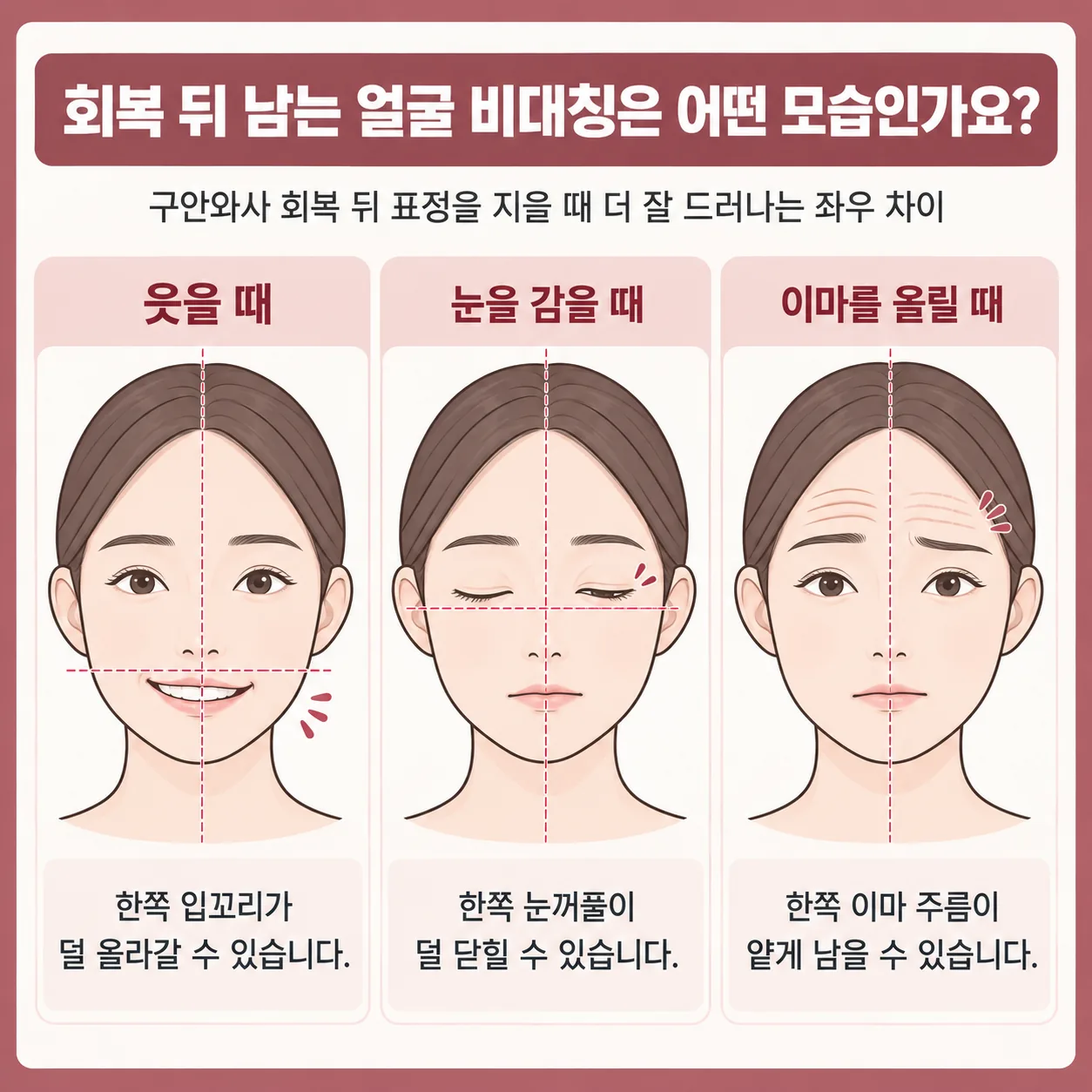 구안와사 회복 뒤 웃을 때와 눈 감을 때, 이마 올릴 때 남는 얼굴 좌우 차이 개념도
