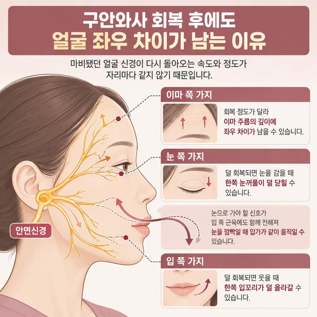 얼굴 신경 가지마다 회복 정도가 달라 좌우 차이가 남는 과정을 나타낸 개념도